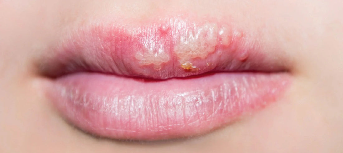 L lysine bij een koortslip
